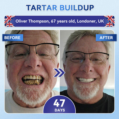 Whiten your teeth in just 7 days 🦷 Glimmerly® Tideglusib Fast‑Dissolving Tooth & Gum Repair Oral Strips ⚡ (Supports tooth repair and helps relieve gum discomfort and other common oral concerns)