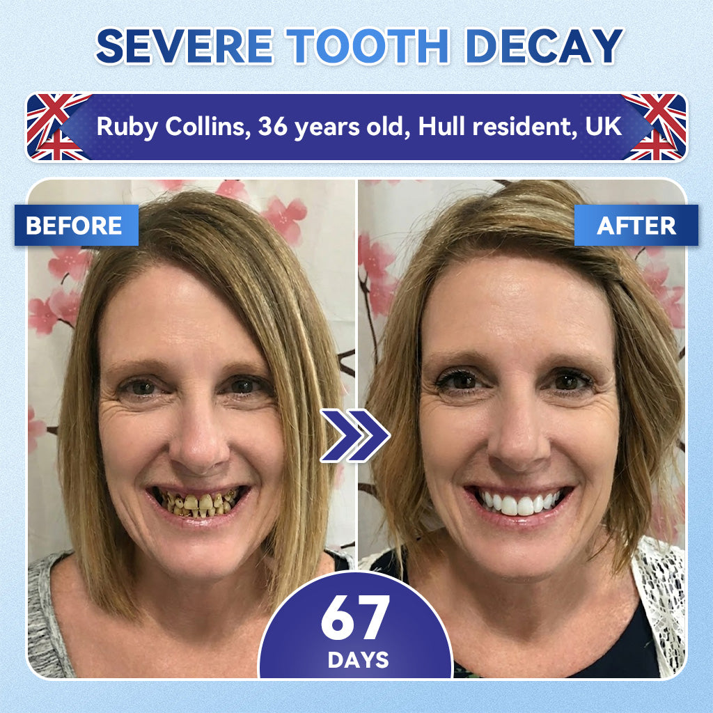 Whiten your teeth in just 7 days 🦷 Glimmerly® Tideglusib Fast‑Dissolving Tooth & Gum Repair Oral Strips ⚡ (Supports tooth repair and helps relieve gum discomfort and other common oral concerns)