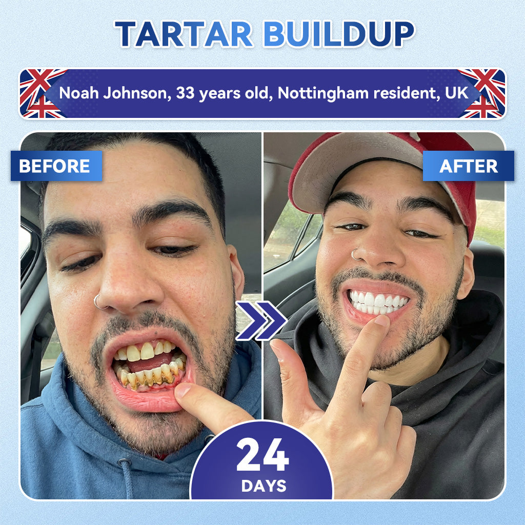 Whiten your teeth in just 7 days 🦷 Glimmerly® Tideglusib Fast‑Dissolving Tooth & Gum Repair Oral Strips ⚡ (Supports tooth repair and helps relieve gum discomfort and other common oral concerns)